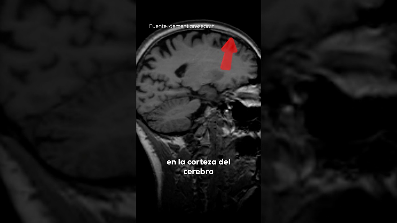 a que edad comienza la atrofia cerebral