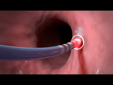 arritmias despues de una ablacion cardiaca