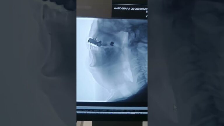 atragantamiento en adultos con agua