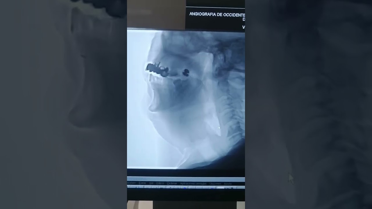 atragantamiento en adultos con agua