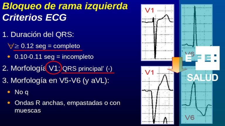bloqueos de rama izquierda y derecha