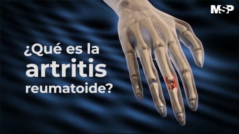 brote de artritis en las manos