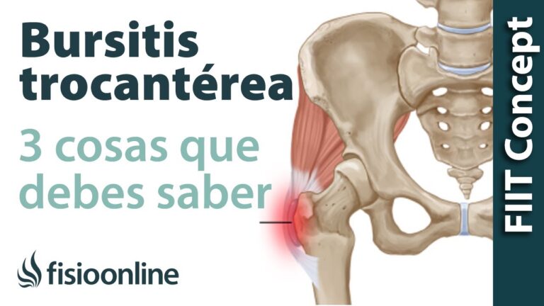 bursitis trocantérea dolor cadera lateral