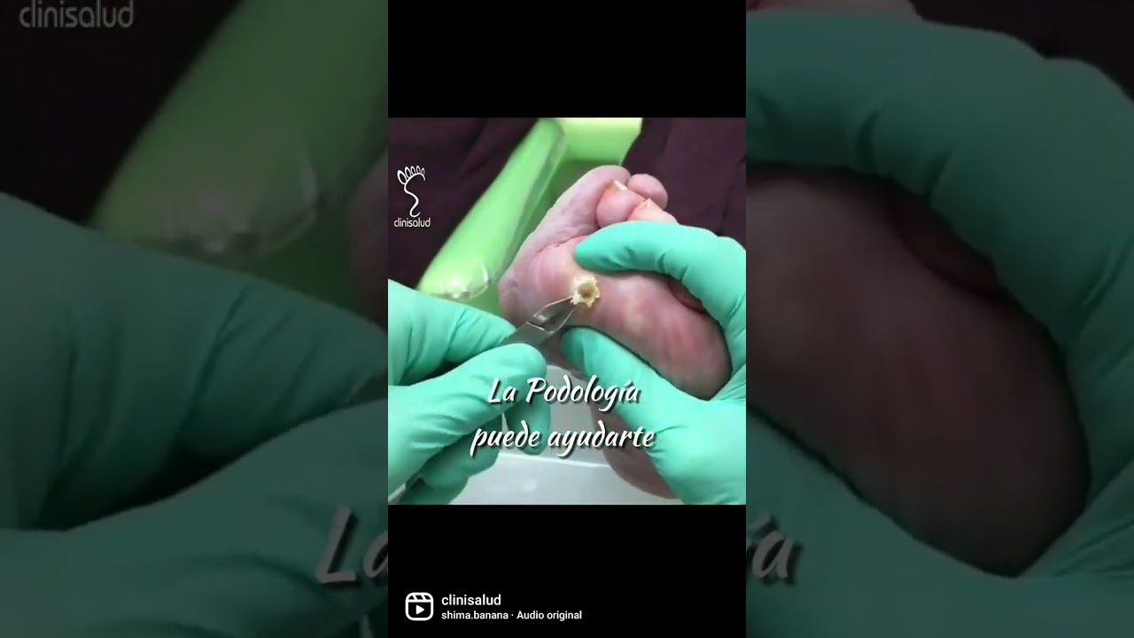 callo en la planta del pie como quitar