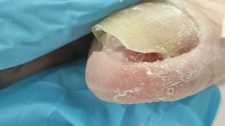 callo en la uña del pie