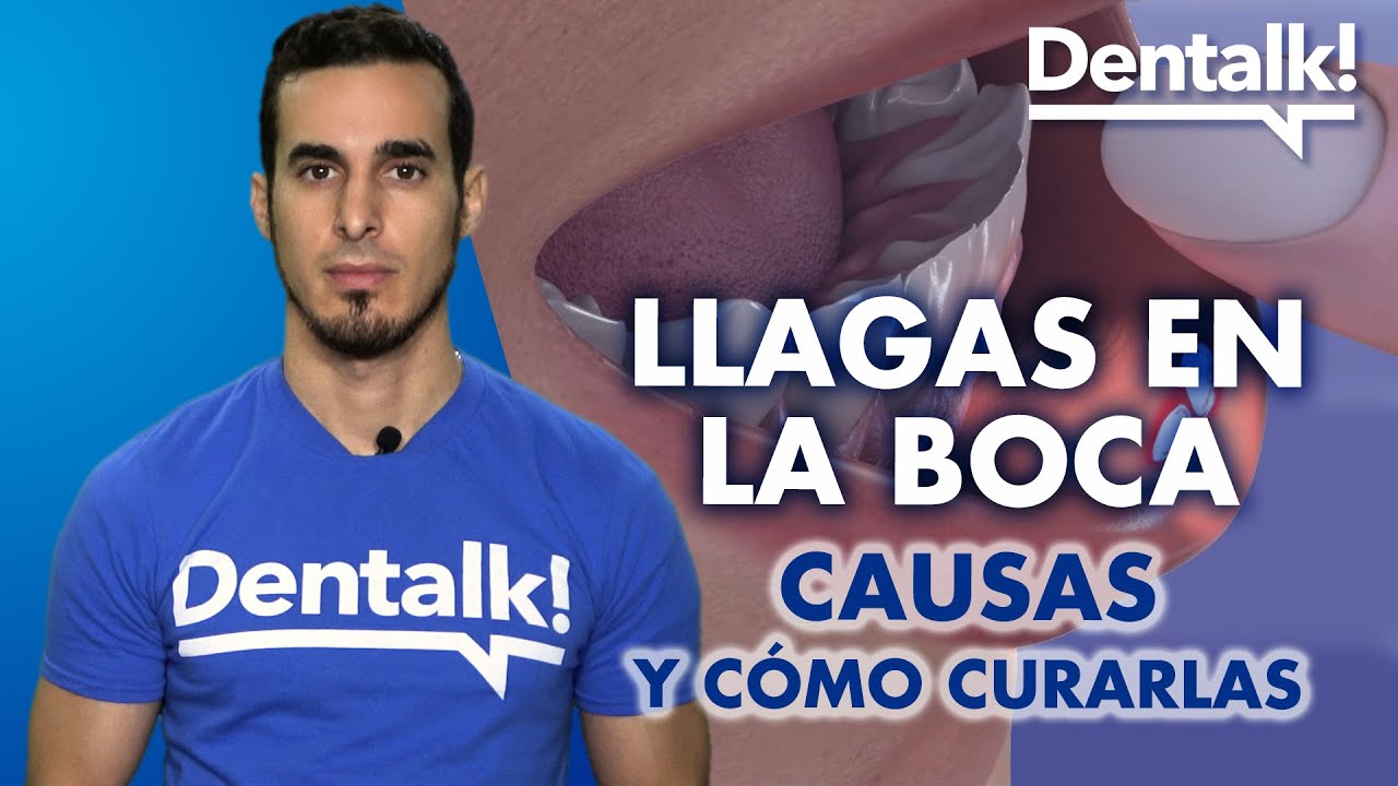 causante de llagas en la boca