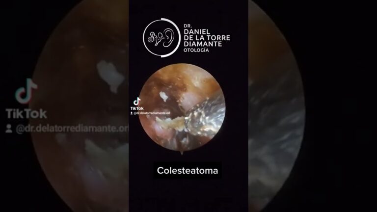colesteatoma quiste en el oido