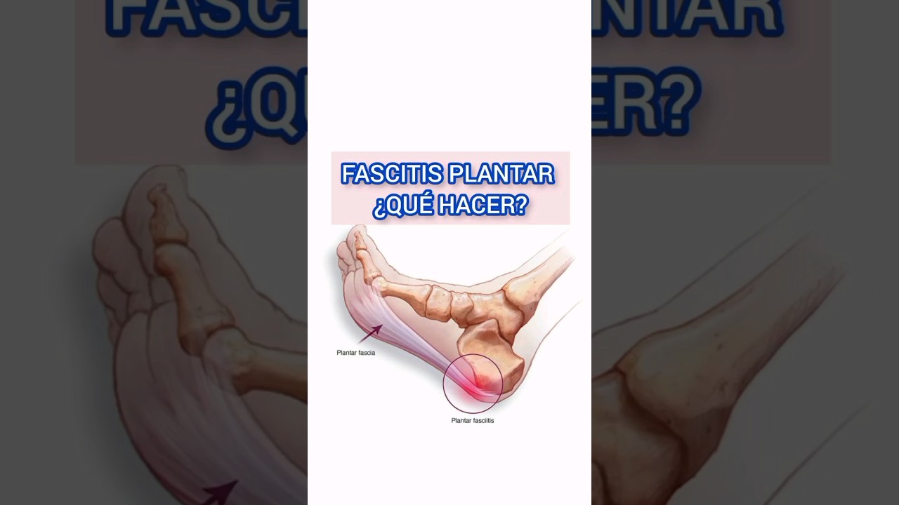 como curar la fascitis plantar rápido