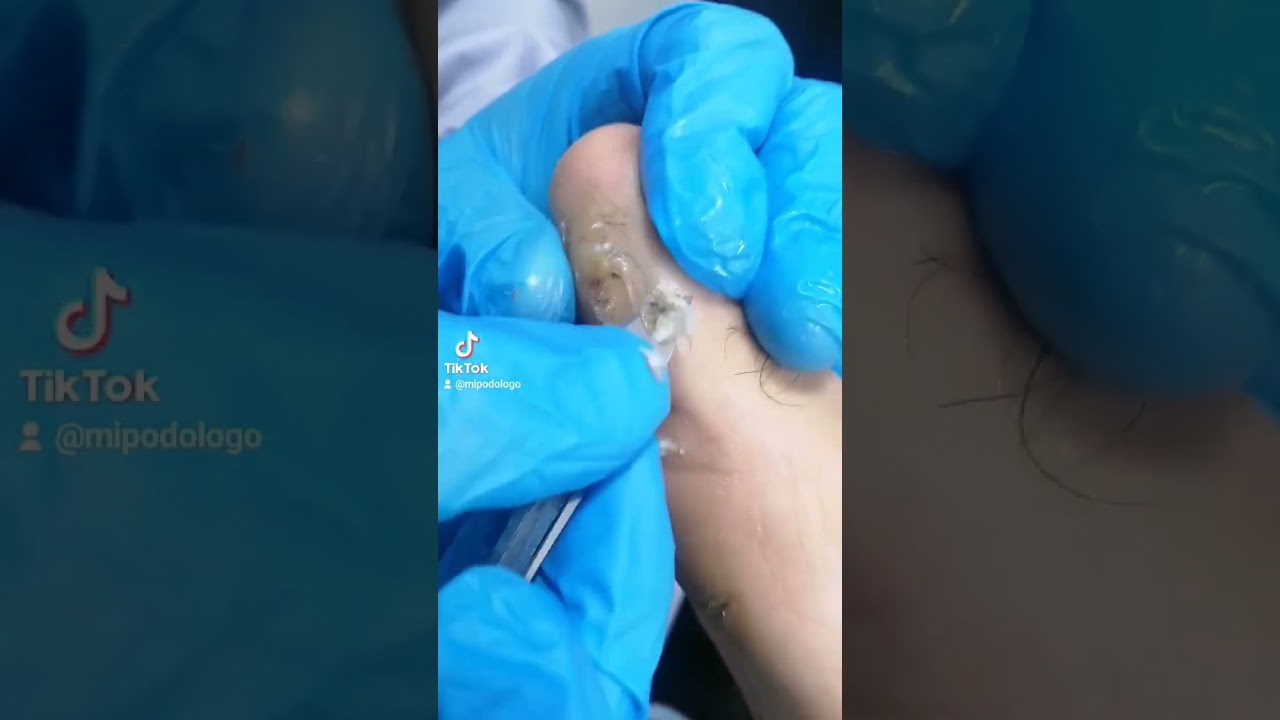 como quitar callos delos dedos delos pies