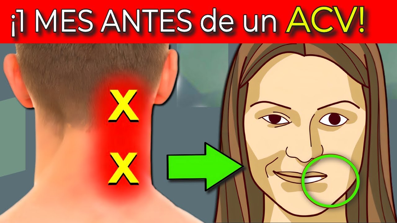 como saber si te esta dando un ictus