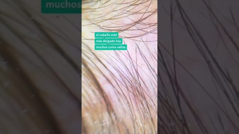 como saber si tengo alopecia mujer