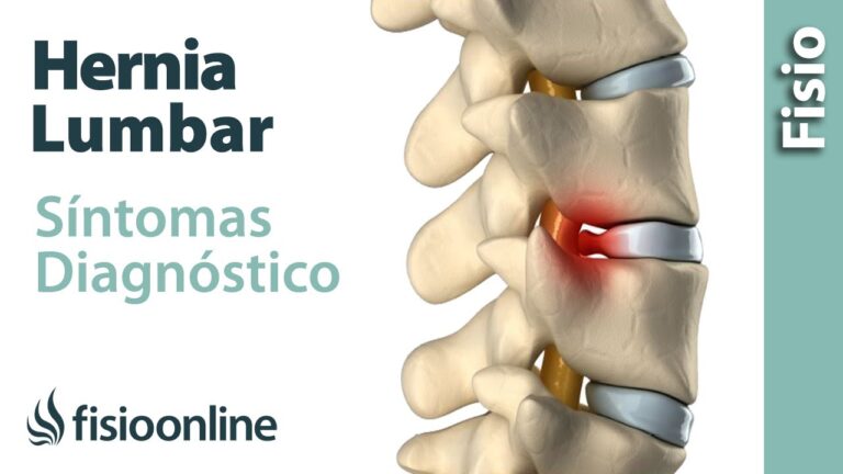 como saber si tengo hernia discal