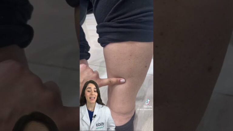 como saber si tengo retención de líquidos