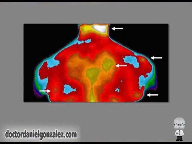 como se detecta la fibromialgia