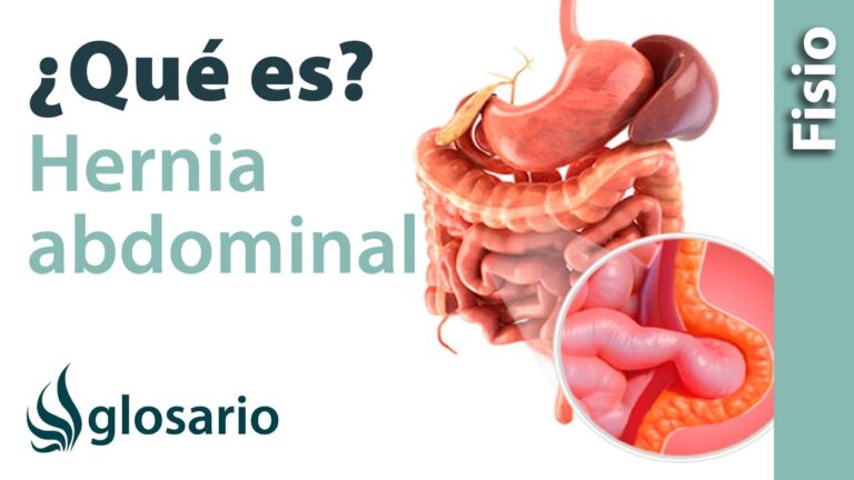 cómo se siente una hernia en el estómago