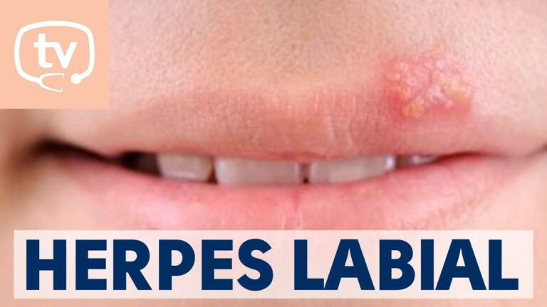 como se transmite herpes labial