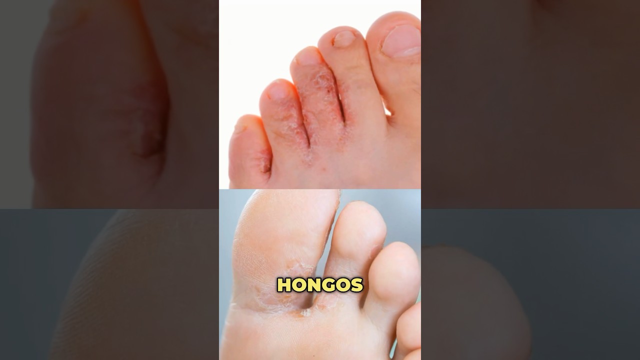 como son los hongos de los pies
