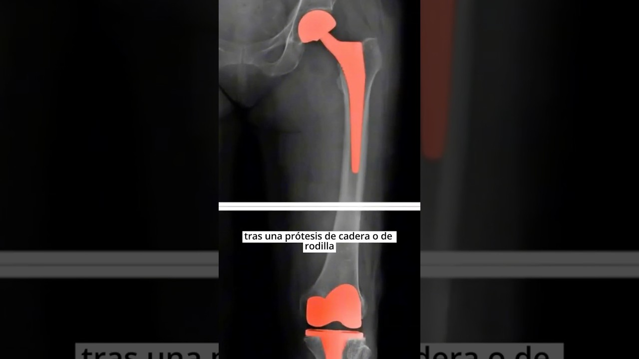 con dos protesis de cadera se puede trabajar