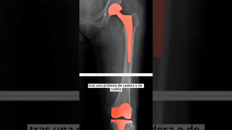 con protesis de cadera se puede trabajar