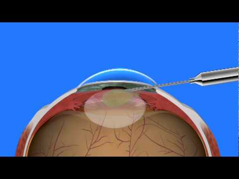 cuando se operan las cataratas