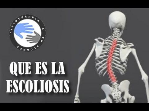 desviaciones en la columna vertebral