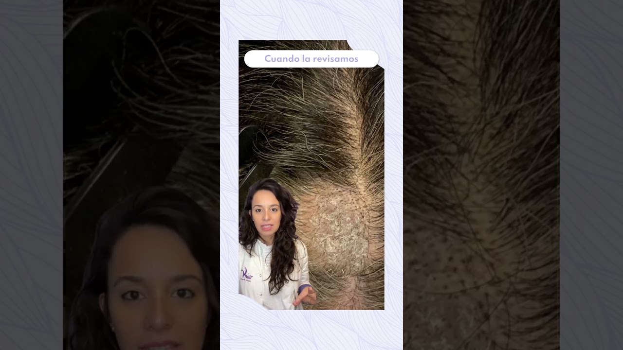 dolor cuero cabelludo al tacto lado izquierdo