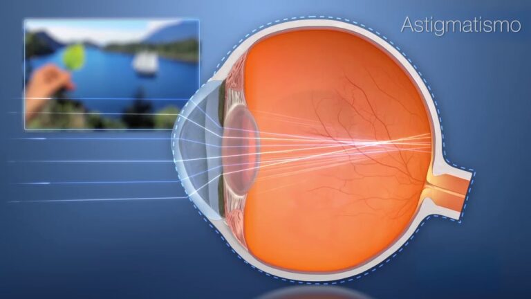 el astigmatismo aumenta con la edad