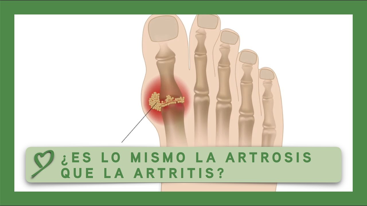 es lo mismo artritis que artrosis