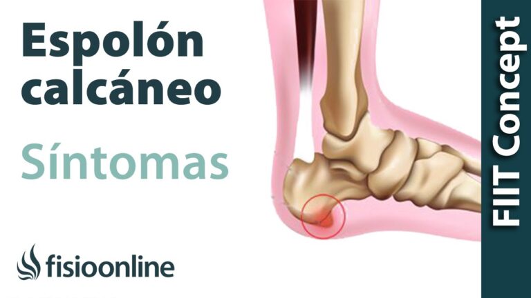espolon en el pie sintomas