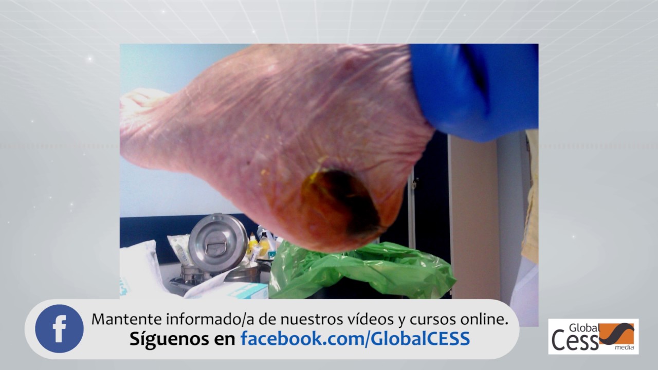 estadios de ulcera por presion