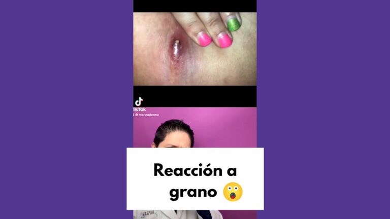 granos internos en las ingles