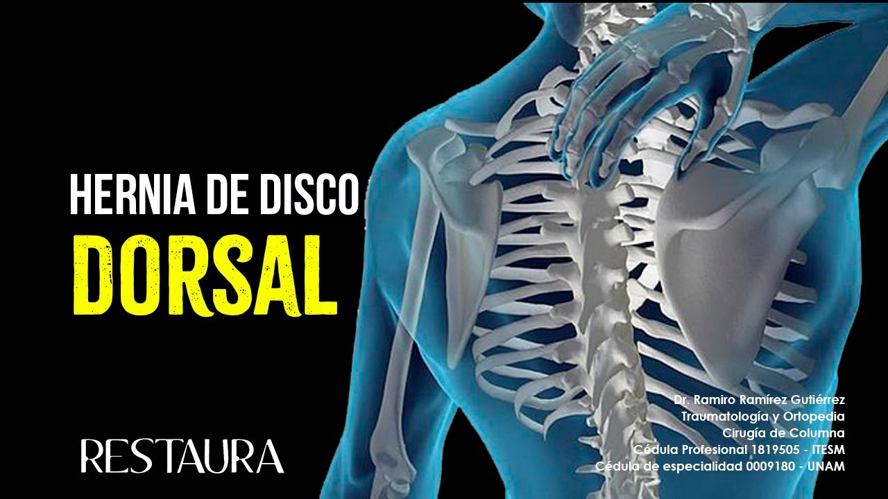 hernia discal dorsal d7 d8 síntomas