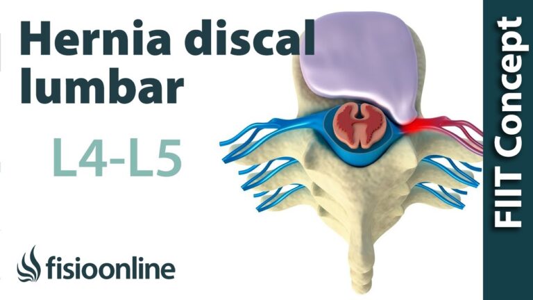 hernia discal l3 l4 sintomas