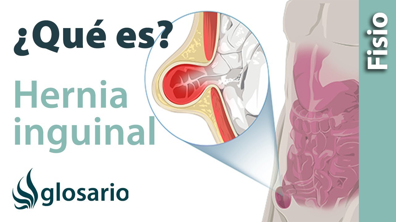 hernia inguinal en mujeres sintomas