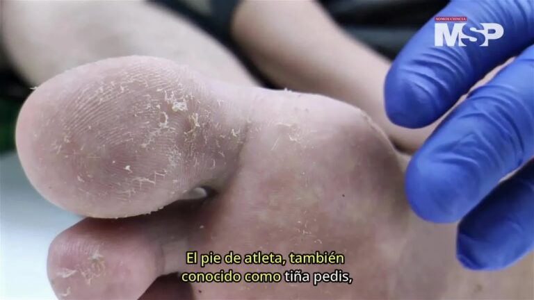 hongos en las plantas de los pies