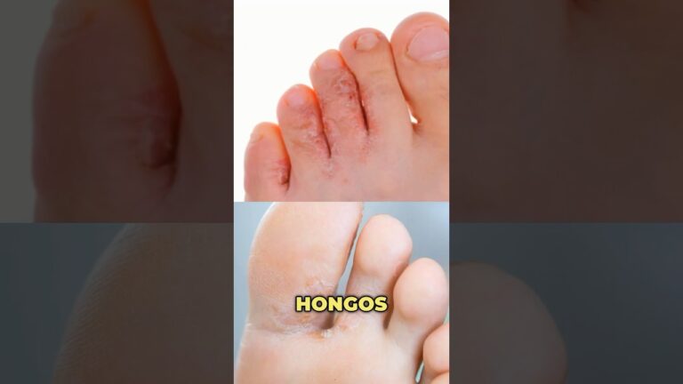hongos en los pies como curarlos