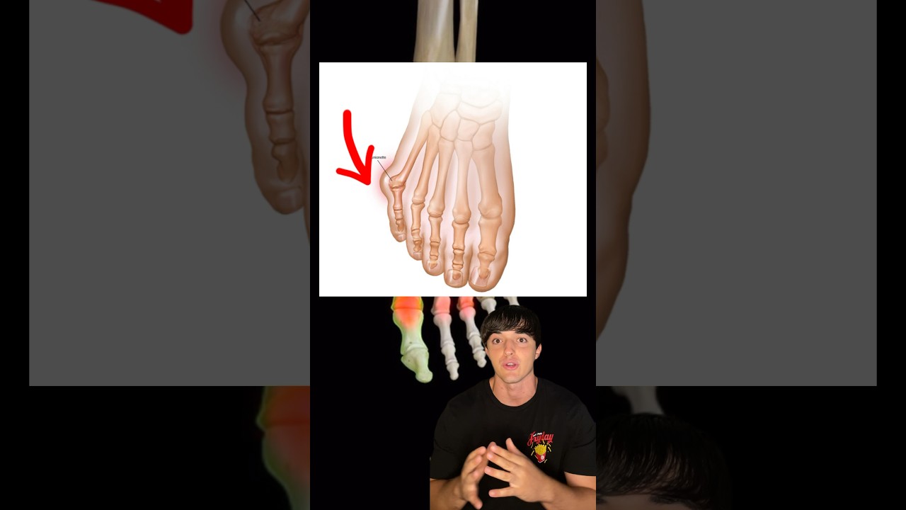 juanetes en el dedo meñique