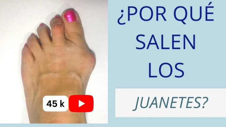 juanetes en los pies porque salen