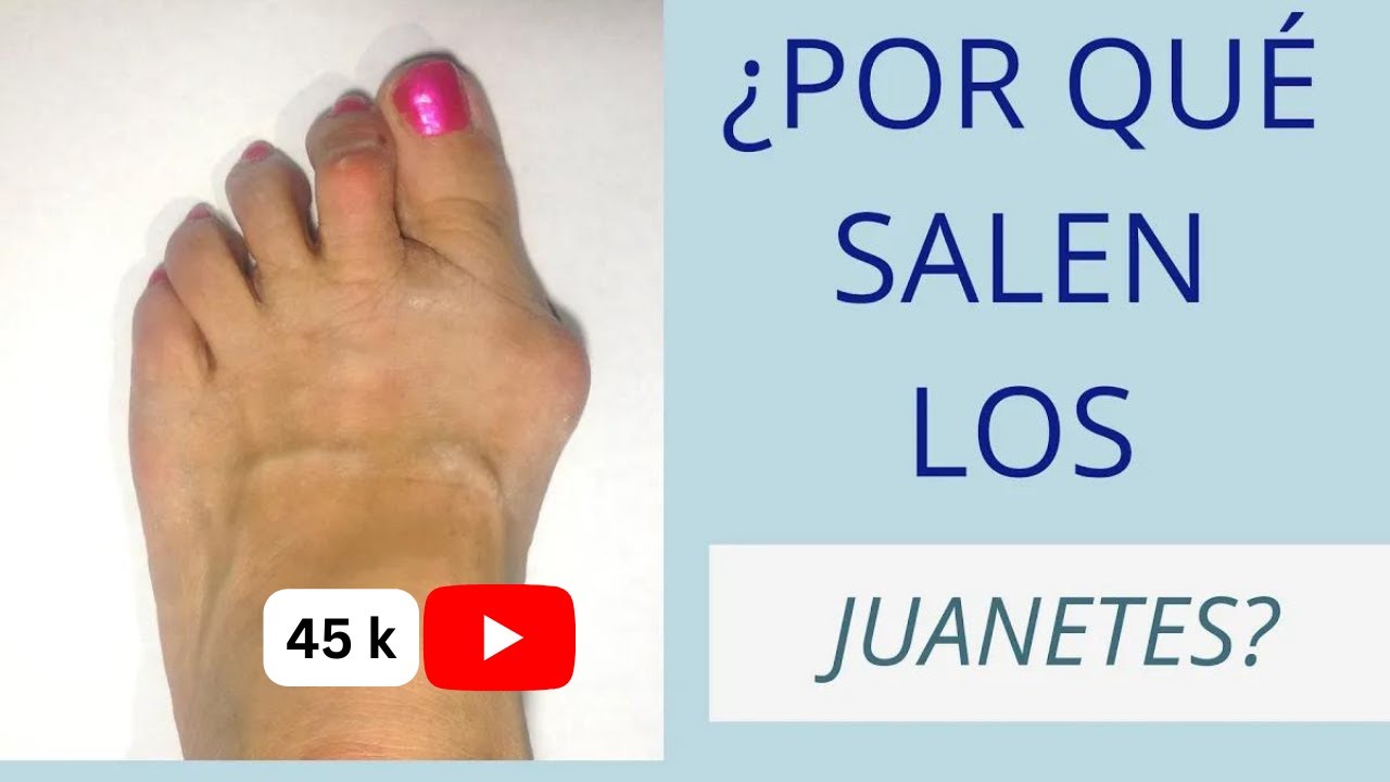 juanetes en los pies porque salen