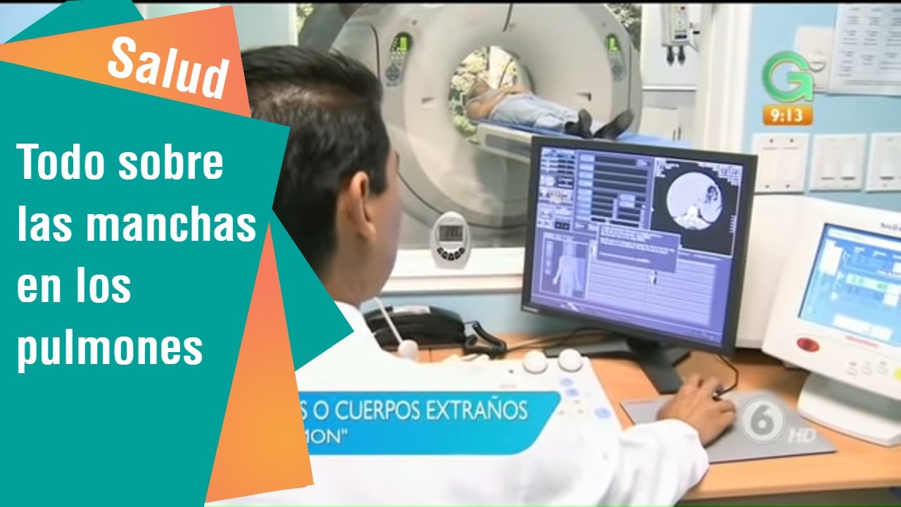 manchas en el pulmon neumonia