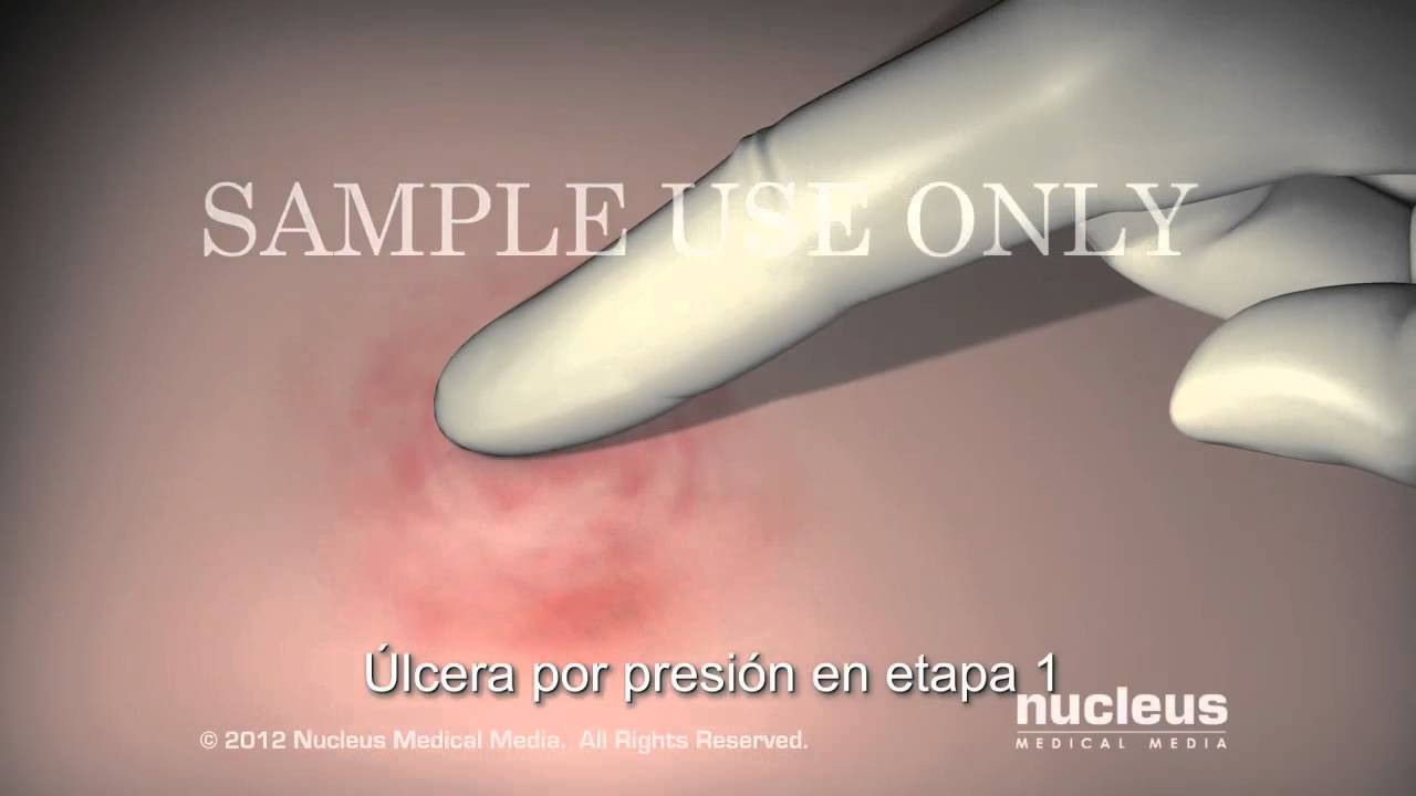 marcas en la piel por presion