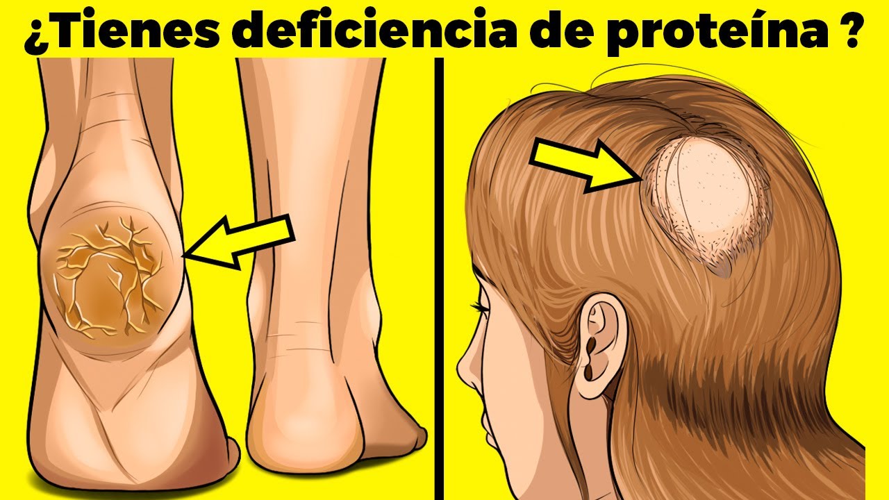muerte por falta de proteínas