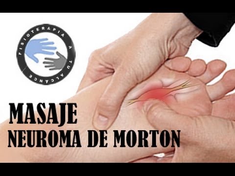 neuroma de morton tratamiento fisioterapia