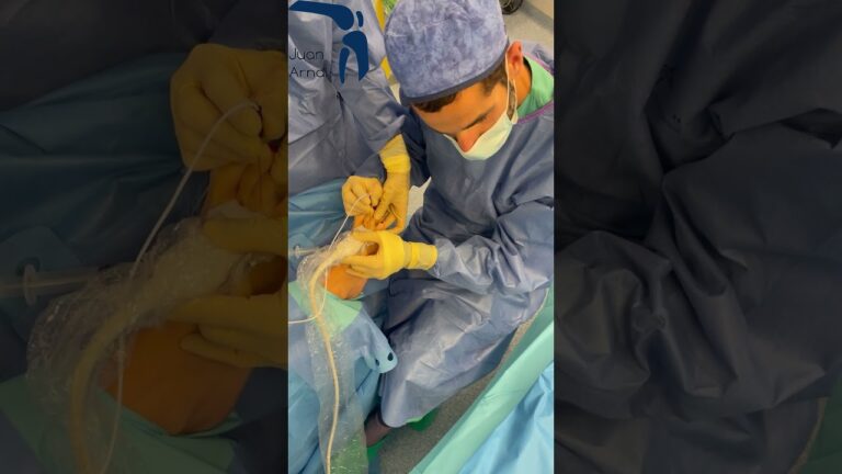 operación neuroma de morton seguridad social