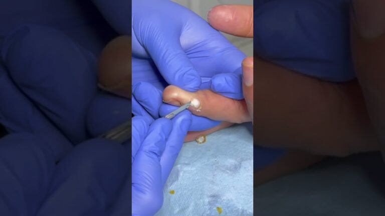 papiloma en el dedo de la mano