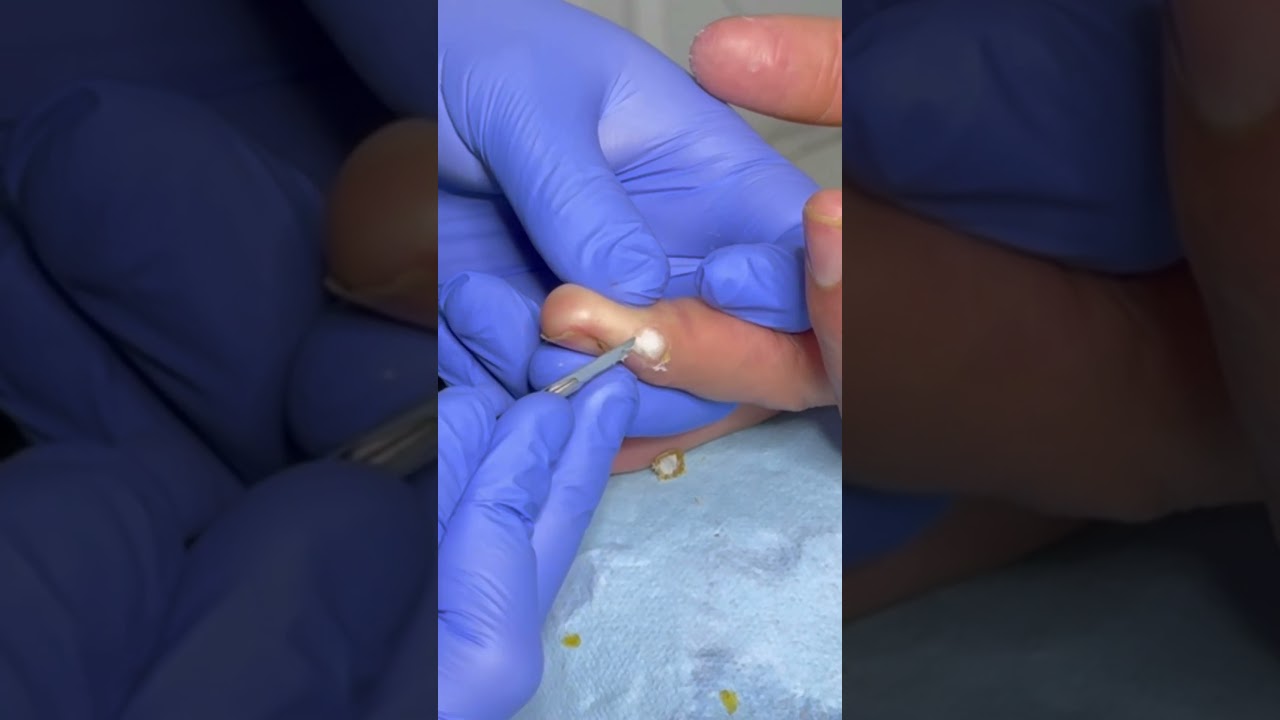 papiloma en el dedo de la mano