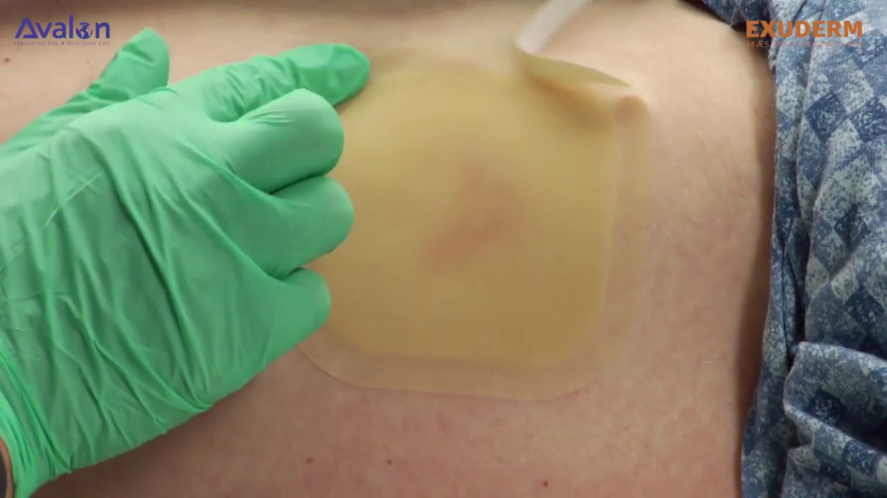 parche para ulceras por presion