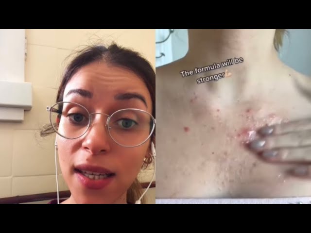 porque me salieron granos en el pecho