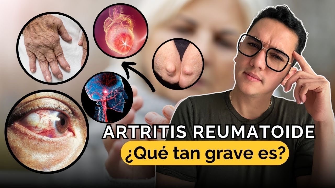 puede morir una persona de artritis reumatoide