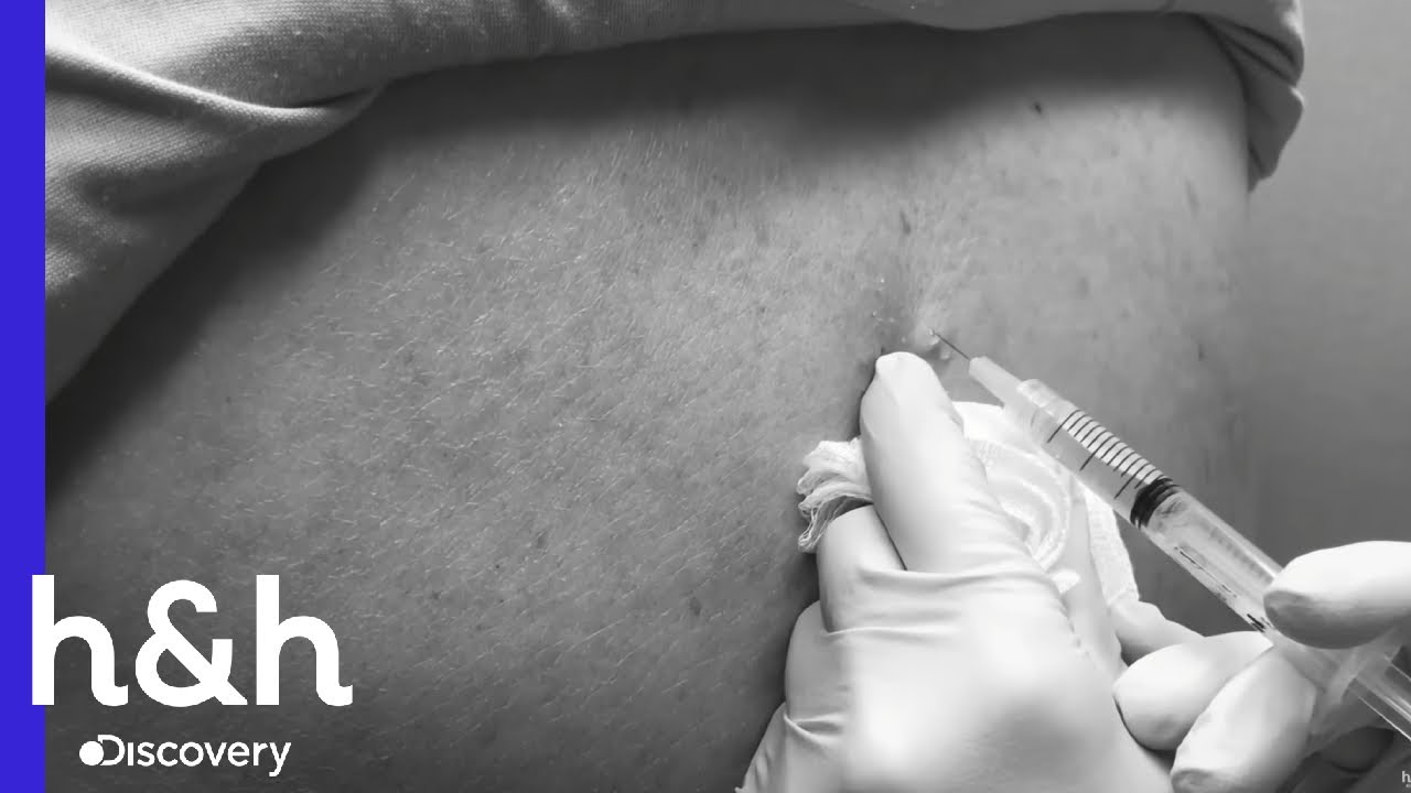 puntos negro en la espalda